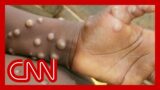 Monkeypox – how does it spread and what are the symptoms?