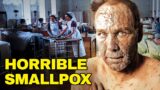 What Life Was Like During A Smallpox Virus Outbreak