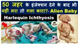 Harlequin Ichthyosis: A severe genetic disorder that affects the skin | Alien Baby #upsc #ias #cse