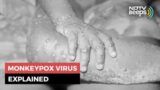 Monkeypox: 5 Things You Should Know About This Rare Virus