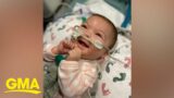 Twin baby with one lung survives against all odds l GMA