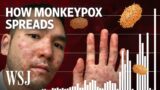 Why Monkeypox Is a Global Health Threat | WSJ