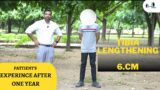 How is recovery after one year of limb lengthening? #heightincreaseinfo #limblengthening