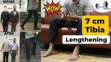 My Full Recovery after 7cm Tibia Limb Lengthening Surgery | LL Success Story LON – Height Increase