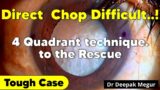 The Classic 4 Quadrant technique to the rescue, when the PHACO CHOP Fails in a Hard Cataract.