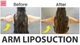 What is Arm Liposuction ?| Results Before and After Lipo Surgery | How to Remove Excess Fat of Arm ?