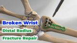 Broken Wrist; Distal Radius Fracture Repair