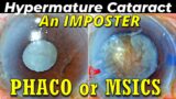 Hypermature cataract , an imposter- MSICS to the rescue – Dr Deepak megur