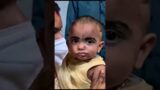Cleft Lip Surgery In India – Before & After Result | Dr Mathew PC #shorts