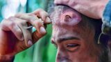 Flesh-eating worms enter his forehead, this man is trapped in a deadly jungle with no way out