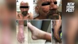 Biblical disease spikes in Florida: CDC’s leprosy alert