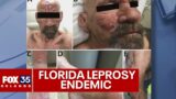 Leprosy 'endemic' in Central Florida, CDC warns