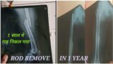 FEMUR FRACTURE ROD REMOVE IN 12 MONTHS| FULL RECOVERY