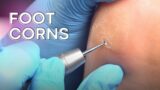 Corn removal and callus reduction – safe and easy!