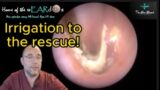 Irrigation to the rescue! 189 #ear #earwax #earwaxremoval #earcleaning #asmr #asmrearwax #satisfying