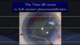 Soft cataract troubleshoot – Visco Lift procedure to the rescue