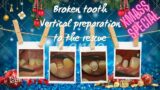 VERTI TO THE RESCUE broken tooth Vertical preparation