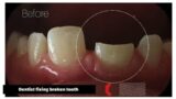 Case treatment: #teeth breaking in small pieces