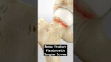 Screwing a femur back together (3D Animation)